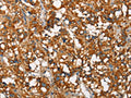 The image on the left is immunohistochemistry of paraffin-embedded Human thyroid cancer tissue using CSB-PA169656(SNCA Antibody) at dilution 1/60, on the right is treated with synthetic peptide. (Original magnification: ×200)