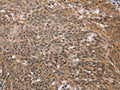 The image on the left is immunohistochemistry of paraffin-embedded Human cervical cancer tissue using CSB-PA170130(ERCC6L Antibody) at dilution 1/30, on the right is treated with fusion protein. (Original magnification: ×200)