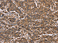 The image on the left is immunohistochemistry of paraffin-embedded Human liver cancer tissue using CSB-PA170264(FABP6 Antibody) at dilution 1/30, on the right is treated with fusion protein. (Original magnification: ×200)