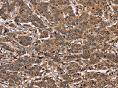 The image on the left is immunohistochemistry of paraffin-embedded Human liver cancer tissue using CSB-PA170264(FABP6 Antibody) at dilution 1/30, on the right is treated with fusion protein. (Original magnification: ×200)