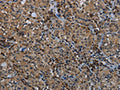 The image on the left is immunohistochemistry of paraffin-embedded Human thyroid cancer tissue using CSB-PA170597(GYS1 Antibody) at dilution 1/40, on the right is treated with fusion protein. (Original magnification: ×200)