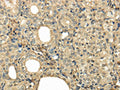 The image on the left is immunohistochemistry of paraffin-embedded Human thyroid cancer tissue using CSB-PA170670(UBE2B Antibody) at dilution 1/30, on the right is treated with fusion protein. (Original magnification: ×200)