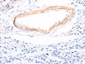 The image on the left is immunohistochemistry of paraffin-embedded Human breast cancer tissue using CSB-PA171540(TPM1 Antibody) at dilution 1/80, on the right is treated with fusion protein. (Original magnification: ×200)
