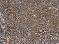 The image on the left is immunohistochemistry of paraffin-embedded Human Lymphoma tissue using CSB-PA172042(TNFRSF8 Antibody) at dilution 1/50, on the right is treated with synthetic peptide. (Original magnification: ×200)