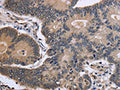 The image is immunohistochemistry of paraffin-embedded Human colon cancer tissue using CSB-PA172178(FSTL1 Antibody) at dilution 1/40. (Original magnification: ×200)