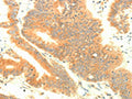 The image on the left is immunohistochemistry of paraffin-embedded Human colon cancer tissue using CSB-PA172305(TRAF3IP2 Antibody) at dilution 1/30, on the right is treated with fusion protein. (Original magnification: ×200)