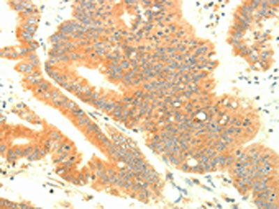 The image on the left is immunohistochemistry of paraffin-embedded Human colon cancer tissue using CSB-PA172305(TRAF3IP2 Antibody) at dilution 1/30, on the right is treated with fusion protein. (Original magnification: ×200)