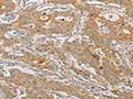 The image on the left is immunohistochemistry of paraffin-embedded Human gastic cancer tissue using CSB-PA172514(ARSK Antibody) at dilution 1/30, on the right is treated with fusion protein. (Original magnification: ×200)