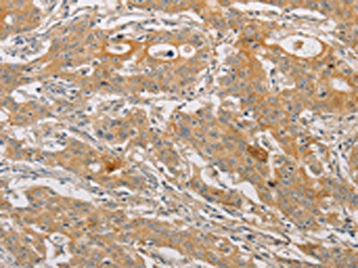 The image on the left is immunohistochemistry of paraffin-embedded Human gastic cancer tissue using CSB-PA172514(ARSK Antibody) at dilution 1/30, on the right is treated with fusion protein. (Original magnification: ×200)