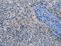 The image on the left is immunohistochemistry of paraffin-embedded Human cervical cancer tissue using CSB-PA173019(MAP2K1 Antibody) at dilution 1/25, on the right is treated with fusion protein. (Original magnification: ×200)