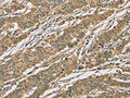 The image on the left is immunohistochemistry of paraffin-embedded Human gastic cancer tissue using CSB-PA173108(EIF3F Antibody) at dilution 1/25, on the right is treated with fusion protein. (Original magnification: ×200)