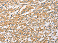 The image on the left is immunohistochemistry of paraffin-embedded Human thyroid cancer tissue using CSB-PA173231(EPS15L1 Antibody) at dilution 1/20, on the right is treated with fusion protein. (Original magnification: ×200)