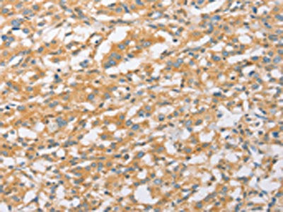 The image on the left is immunohistochemistry of paraffin-embedded Human thyroid cancer tissue using CSB-PA173231(EPS15L1 Antibody) at dilution 1/20, on the right is treated with fusion protein. (Original magnification: ×200)