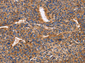 The image on the left is immunohistochemistry of paraffin-embedded Human liver cancer tissue using CSB-PA173238(ITGB1 Antibody) at dilution 1/50, on the right is treated with fusion protein. (Original magnification: ×200)