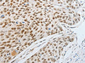 The image on the left is immunohistochemistry of paraffin-embedded Human esophagus cancer tissue using CSB-PA173368(MITF Antibody) at dilution 1/20, on the right is treated with fusion protein. (Original magnification: X200)
