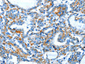 The image on the left is immunohistochemistry of paraffin-embedded Human thyroid cancer tissue using CSB-PA173556(BACE1 Antibody) at dilution 1/15, on the right is treated with fusion protein. (Original magnification: ×200)