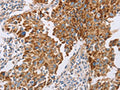 The image on the left is immunohistochemistry of paraffin-embedded Human lung cancer tissue using CSB-PA173685(GUCY1A3 Antibody) at dilution 1/40, on the right is treated with fusion protein. (Original magnification: ×200)