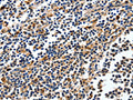 The image on the left is immunohistochemistry of paraffin-embedded Human tonsil tissue using CSB-PA173796(NFKBID Antibody) at dilution 1/25, on the right is treated with fusion protein. (Original magnification: ×200)