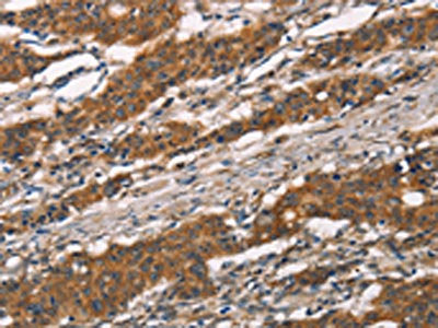 The image on the left is immunohistochemistry of paraffin-embedded Human gastic cancer tissue using CSB-PA174054(MMP2 Antibody) at dilution 1/30, on the right is treated with synthetic peptide. (Original magnification: ×200)