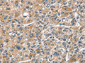 The image on the left is immunohistochemistry of paraffin-embedded Human liver cancer tissue using CSB-PA174578(CHMP4B Antibody) at dilution 1/40, on the right is treated with fusion protein. (Original magnification: ×200)