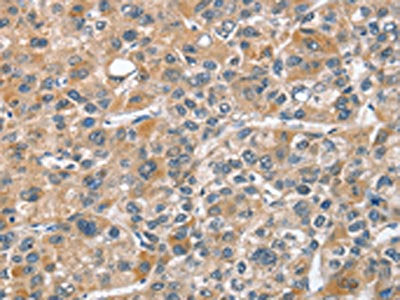 The image on the left is immunohistochemistry of paraffin-embedded Human liver cancer tissue using CSB-PA174578(CHMP4B Antibody) at dilution 1/40, on the right is treated with fusion protein. (Original magnification: ×200)