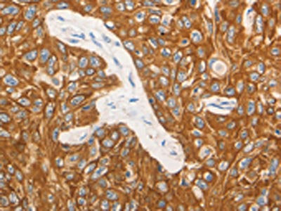 The image on the left is immunohistochemistry of paraffin-embedded Human esophagus cancer tissue using CSB-PA174940(CSF3 Antibody) at dilution 1/15, on the right is treated with synthetic peptide. (Original magnification: ×200)