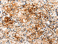 The image on the left is immunohistochemistry of paraffin-embedded Human renal cancer tissue using CSB-PA175313(IRAK2 Antibody) at dilution 1/120, on the right is treated with fusion protein. (Original magnification: ×200)