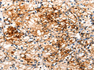 The image on the left is immunohistochemistry of paraffin-embedded Human renal cancer tissue using CSB-PA175313(IRAK2 Antibody) at dilution 1/120, on the right is treated with fusion protein. (Original magnification: ×200)