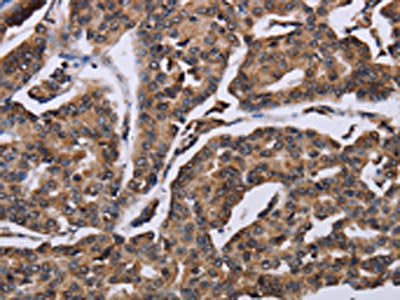 The image on the left is immunohistochemistry of paraffin-embedded Human breast cancer tissue using CSB-PA175695(KIF1C Antibody) at dilution 1/60, on the right is treated with fusion protein. (Original magnification: ×200)