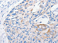 The image on the left is immunohistochemistry of paraffin-embedded Human esophagus cancer tissue using CSB-PA176239(FANCF Antibody) at dilution 1/100, on the right is treated with fusion protein. (Original magnification: ×200)