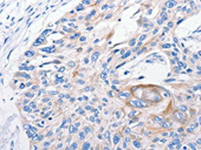 The image on the left is immunohistochemistry of paraffin-embedded Human esophagus cancer tissue using CSB-PA176239(FANCF Antibody) at dilution 1/100, on the right is treated with fusion protein. (Original magnification: ×200)