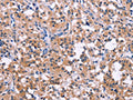 The image on the left is immunohistochemistry of paraffin-embedded Human thyroid cancer tissue using CSB-PA176280(DUSP13 Antibody) at dilution 1/50, on the right is treated with fusion protein. (Original magnification: ×200)