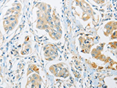 The image on the left is immunohistochemistry of paraffin-embedded Human breast cancer tissue using CSB-PA176345(ARHGEF10 Antibody) at dilution 1/45, on the right is treated with fusion protein. (Original magnification: ×200)