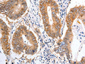 The image on the left is immunohistochemistry of paraffin-embedded Human colon cancer tissue using CSB-PA176370(PIWIL1 Antibody) at dilution 1/25, on the right is treated with fusion protein. (Original magnification: ×200)