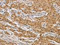 The image on the left is immunohistochemistry of paraffin-embedded Human gastic cancer tissue using CSB-PA176612(ARHGAP25 Antibody) at dilution 1/40, on the right is treated with fusion protein. (Original magnification: ×200)