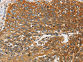 The image on the left is immunohistochemistry of paraffin-embedded Human cervical cancer tissue using CSB-PA176976(DCTN2 Antibody) at dilution 1/25, on the right is treated with fusion protein. (Original magnification: ×200)