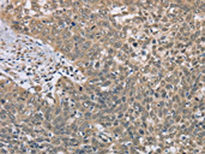 The image on the left is immunohistochemistry of paraffin-embedded Human cervical cancer tissue using CSB-PA177824(DACH2 Antibody) at dilution 1/40, on the right is treated with fusion protein. (Original magnification: ×200)