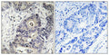Immunohistochemical analysis of paraffin-embedded human colon carcinoma tissue using Inos (Phospho-Tyr151) antibody (left)or the same antibody preincubated with blocking peptide (right).