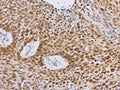 The image on the left is immunohistochemistry of paraffin-embedded Human lung cancer tissue using CSB-PA178630(MCM5 Antibody) at dilution 1/40, on the right is treated with fusion protein. (Original magnification: ×200)
