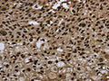 The image on the left is immunohistochemistry of paraffin-embedded Human esophagus cancer tissue using CSB-PA178639(ANP32E Antibody) at dilution 1/20, on the right is treated with synthetic peptide. (Original magnification: ×200)