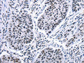 The image on the left is immunohistochemistry of paraffin-embedded Human lung cancer tissue using CSB-PA178769(HSPB2 Antibody) at dilution 1/5, on the right is treated with fusion protein. (Original magnification: ×200)