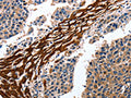 The image on the left is immunohistochemistry of paraffin-embedded Human liver cancer tissue using CSB-PA178836(CYP3A4 Antibody) at dilution 1/15, on the right is treated with fusion protein. (Original magnification: ×200)