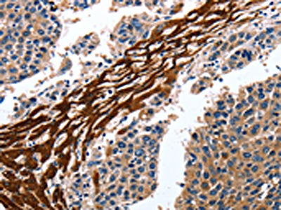 The image on the left is immunohistochemistry of paraffin-embedded Human liver cancer tissue using CSB-PA178836(CYP3A4 Antibody) at dilution 1/15, on the right is treated with fusion protein. (Original magnification: ×200)