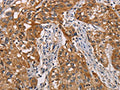 The image on the left is immunohistochemistry of paraffin-embedded Human esophagus cancer tissue using CSB-PA178887(CRYAB Antibody) at dilution 1/25, on the right is treated with fusion protein. (Original magnification: ×200)