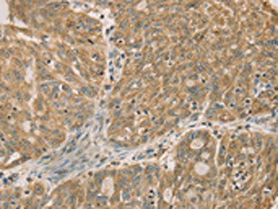 The image on the left is immunohistochemistry of paraffin-embedded Human ovarian cancer tissue using CSB-PA178912(DMRT3 Antibody) at dilution 1/50, on the right is treated with fusion protein. (Original magnification: ×200)