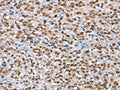 The image on the left is immunohistochemistry of paraffin-embedded Human esophagus cancer tissue using CSB-PA178919(MCM6 Antibody) at dilution 1/60, on the right is treated with fusion protein. (Original magnification: ×200)