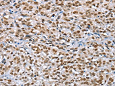 The image on the left is immunohistochemistry of paraffin-embedded Human esophagus cancer tissue using CSB-PA178919(MCM6 Antibody) at dilution 1/60, on the right is treated with fusion protein. (Original magnification: ×200)