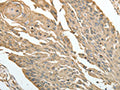 The image on the left is immunohistochemistry of paraffin-embedded Human cervical cancer tissue using CSB-PA179036(HSP90B1 Antibody) at dilution 1/30, on the right is treated with fusion protein. (Original magnification: ×200)