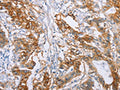The image on the left is immunohistochemistry of paraffin-embedded Human colon cancer tissue using CSB-PA179189(CA9 Antibody) at dilution 1/50, on the right is treated with fusion protein. (Original magnification: ×200)