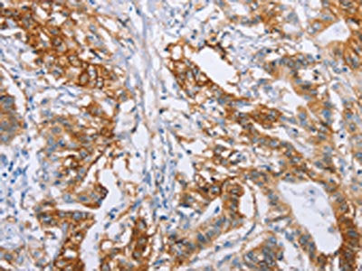 The image on the left is immunohistochemistry of paraffin-embedded Human colon cancer tissue using CSB-PA179189(CA9 Antibody) at dilution 1/50, on the right is treated with fusion protein. (Original magnification: ×200)